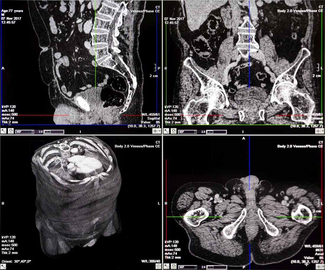 What is the Difference between Cat Scan And Ct Scan